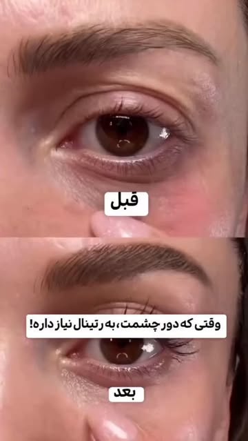 دور چشم نامبوزین